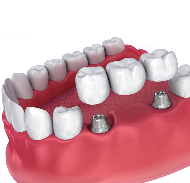 Root Canals - Cicero Smile Dental Building Trust & Creating Smiles